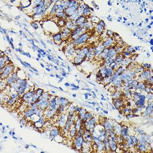 Immunohistochemistry analysis of paraffin-embedded human colon carcinoma tissue using Anti-JAK1 Antibody [ARC0434] (A80915) at a dilution of 1:100 (40X lens). Perform microwave antigen retrieval with 10 mM PBS buffer pH 7.2 before commencing with IHC staining protocol