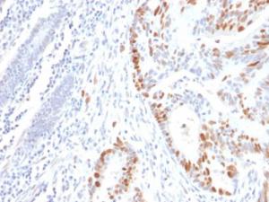 Immunohistochemical analysis of formalin-fixed, paraffin-embedded human colon carcinoma using Anti-p53 Antibody [rBP53-12]