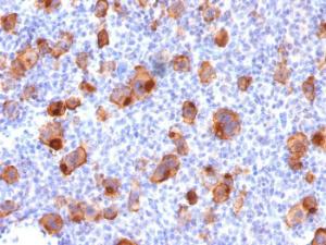 Immunohistochemical analysis of formalin-fixed, paraffin-embedded human Hodgkin's lymphoma using Anti-CD30 Antibody [rKi-1/779]