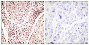 Immunohistochemical analysis of paraffin-embedded human breast carcinoma using Anti-Chk2 (phospho Thr387) Antibody. The right hand panel represents a negative control, where the antibody was pre-incubated with the immunising peptide.