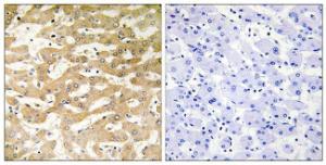 Immunohistochemical analysis of paraffin-embedded human liver carcinoma tissue using Anti-FADD Antibody. The right hand panel represents a negative control, where the antibody was pre-incubated with the immunising peptide