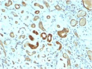 Immunohistochemical analysis of formalin-fixed, paraffin-embedded human renal cell carcinoma using Anti-STAT3 Antibody [STAT3/2409]