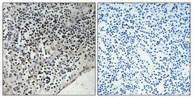 Immunohistochemical analysis of paraffin-embedded human lung cancer using Anti-CDC37 (phospho Ser13) Antibody 1:100 (4°C overnight). The right hand panel represents a negative control, where the antibody was pre-incubated with the immunising peptide