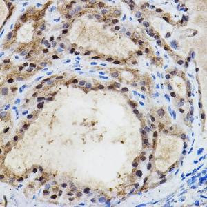 Immunohistochemistry analysis of paraffin-embedded human thyroid cancer using Anti-HIF-2-alpha Antibody (A10163) at a dilution of 1:100 (40X lens). Perform high pressure antigen retrieval with 10 mM citrate buffer pH 6.0 before commencing with IHC staining protocol