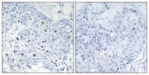 Immunohistochemical analysis of paraffin-embedded human breast cancer using Anti-BAF250B Antibody 1:100 (4 °C overnight). The right hand panel represents a negative control, where the antibody was pre-incubated with the immunising peptide