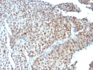 Immunohistochemical analysis of formalin-fixed, paraffin-embedded human bladder carcinoma using Anti-p53 Antibody [SPM589]