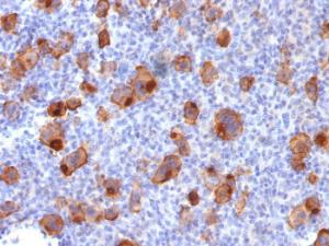 Immunohistochemical analysis of formalin-fixed, paraffin-embedded human Hodgkin's lymphoma using Anti-CD30 Antibody [Ki-1/1747R]