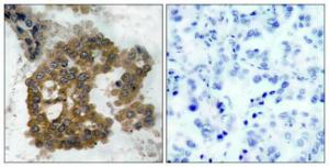 Immunohistochemical analysis of paraffin-embedded human lung carcinoma using Anti-Akt2 (phospho Ser474) Antibody. The right hand panel represents a negative control, where the antibody was pre-incubated with the immunising peptide.