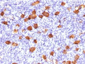 Immunohistochemical analysis of formalin-fixed, paraffin-embedded human Hodgkin's lymphoma using Anti-CD30 Antibody