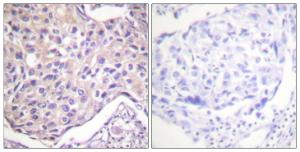 Immunohistochemical analysis of paraffin-embedded human breast carcinoma using Anti-GRK2 (phospho Ser29) Antibody. The right hand panel represents a negative control, where the Antibody was pre-incubated with the immunising peptide