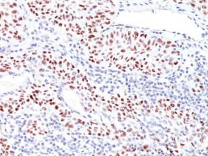 Immunohistochemical analysis of formalin-fixed, paraffin-embedded human bladder carcinoma using Anti-p53 Antibody [TRP/816]