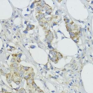 Immunohistochemistry analysis of paraffin-embedded human mammary cancer using Anti-BMPR1B Antibody (A307509) at a dilution of 1:200 (40X lens). Perform microwave antigen retrieval with 10 mM PBS buffer pH 7.2 before commencing with IHC staining protocol