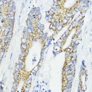 Immunohistochemistry analysis of paraffin-embedded human colon carcinoma tissue using Anti-BMPR1B Antibody (A307509) at a dilution of 1:200 (40X lens). Perform microwave antigen retrieval with 10 mM PBS buffer pH 7.2 before commencing with IHC staining protocol