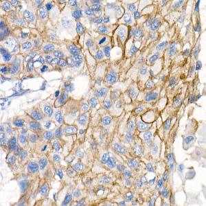 Immunohistochemistry analysis of paraffin-embedded human lung squamous carcinoma tissue using Anti-delta 1 Catenin/CAS Antibody [ARC0586] (A81041) at a dilution of 1:500 (40x lens) Perform microwave antigen retrieval with 10 mM PBS buffer pH 72 before commencing with IHC staining protocol