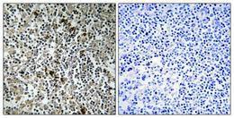 Immunohistochemical analysis of paraffin-embedded human lung cancer using Anti-MRPL4 Antibody 1:100 (4 °C overnight). The right hand panel represents a negative control, where the Antibody was pre-incubated with the immunising peptide