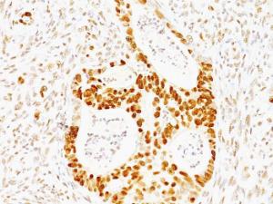 Immunohistochemical analysis of formalin-fixed, paraffin-embedded human colon carcinoma using Anti-p53 Antibody [TRP/817]