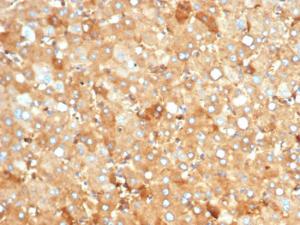 Immunohistochemical analysis of formalin-fixed, paraffin-embedded human liver carcinoma in colon using Anti-Albumin Antibody [rALB/6412]