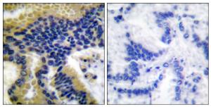 Immunohistochemical analysis of paraffin-embedded human lung carcinoma tissue using Anti-Caspase 9 (cleaved Asp330) Antibody The right hand panel represents a negative control, where the antibody was pre-incubated with the immunising peptide