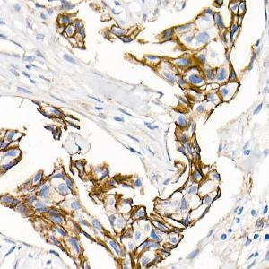 Immunohistochemistry analysis of paraffin-embedded human breast ductal carcinoma tissue using Anti-delta 1 Catenin/CAS Antibody [ARC0586] (A81041) at a dilution of 1:500 (40x lens) Perform microwave antigen retrieval with 10 mM PBS buffer pH 72 before commencing with IHC staining protocol