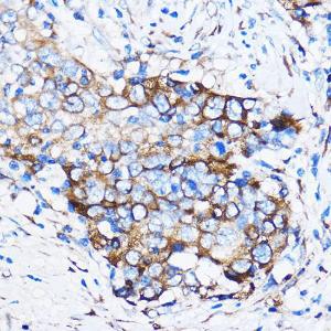 Immunohistochemistry analysis of paraffin-embedded human esophageal cancer using Anti-Chk1 Antibody (A10183) at a dilution of 1:50 (40X lens). Perform microwave antigen retrieval with 10 mM PBS buffer pH 7.2 before commencing with IHC staining protocol