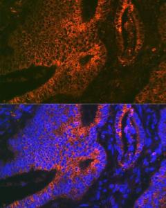 Immunofluorescence analysis of human colon carcinoma using Anti-ADAM15 Antibody [ARC1419] (A308455) at a dilution of 1:100 (40X lens). DAPI was used to stain the cell nuclei (blue)