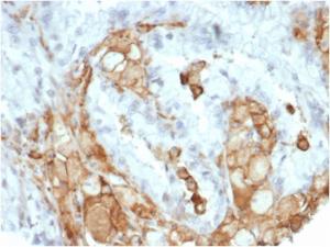 Immunohistochemical analysis of formalin-fixed, paraffin-embedded human colon carcinoma tissue using Anti-IL-2 Antibody [IL2/7050R]