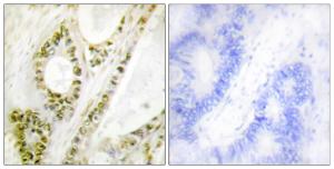 Immunohistochemical analysis of paraffin-embedded human colon carcinoma using Anti-IRF-3 (phospho Ser385) Antibody The right hand panel represents a negative control, where the antibody was pre-incubated with the immunising peptide