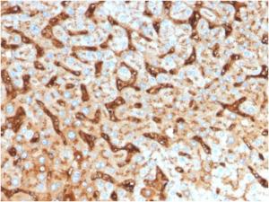 Immunohistochemical analysis of formalin-fixed, paraffin-embedded human hepatocellular carcinoma using Anti-Albumin Antibody [ALB/2144]