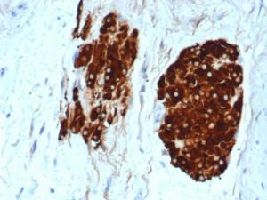 Immunohistochemical analysis of formalin-fixed, paraffin-embedded human testicular carcinoma using Anti-Inhibin alpha Antibody [INHA/6598R] at 2 µg/ml in PBS for 30  minutes at room temperature