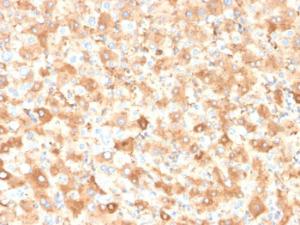 Immunohistochemical analysis of formalin-fixed, paraffin-embedded human liver carcinoma in colon using Anti-Albumin Antibody [ALB/2355]