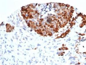 Immunohistochemical analysis of formalin-fixed, paraffin-embedded human bladder carcinoma tissue using Anti-INSM1 Antibody [INSM1/6286R]