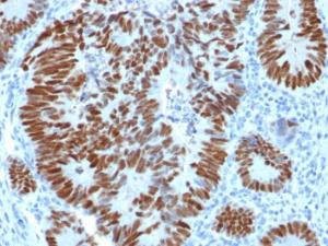 Immunohistochemical analysis of formalin-fixed, paraffin-embedded human colon carcinoma using Anti-p53 Antibody