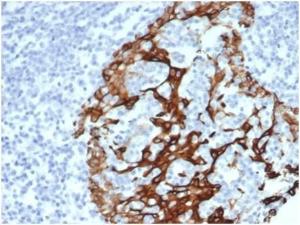 Immunohistochemical analysis of formalin-fixed, paraffin-embedded human prostate tissue using Anti-Cytokeratin 6A Antibody [KRT6/3997R]