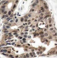 Immunohistochemical analysis of paraffin-embedded human breast carcinoma tissue using 4E-BP1 (Ab-36).