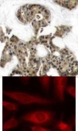 \<b&#62;Top Image:\</b&#62; Immunohistochemical analysis of paraffin-embedded human breast carcinoma tissue using 4E-BP1 (Ab-45).\<b&#62;Bottom Image:\</b&#62; Immunofluorescence staining of methanol-fixed HeLa cells using 4E-BP1 (Ab-45).