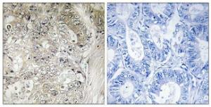 Immunohistochemical analysis of paraffin-embedded human colon carcinoma tissue using Anti-CST1 Antibody. The right hand panel represents a negative control, where the antibody was pre-incubated with the immunising peptide