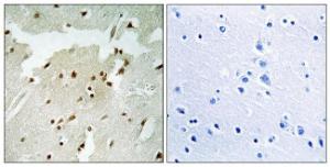 Immunohistochemical analysis of paraffin-embedded human lung carcinoma using Anti-Ku70 (phospho Ser5) Antibody. The right hand panel represents a negative control, where the antibody was pre-incubated with the immunising peptide