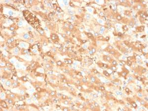 Immunohistochemical analysis of formalin-fixed, paraffin-embedded human liver carcinoma in colon using Anti-Albumin Antibody [ALB/6413R]