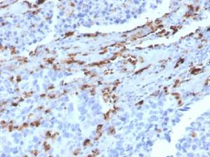 Immunohistochemical analysis of formalin-fixed, paraffin-embedded human lung adenocarcinoma using Anti-NAPSIN A Antibody [NAPSA/3309]