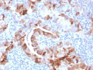 Immunohistochemical analysis of formalin-fixed, paraffin-embedded human thyroid carcinoma using Anti-Thyroid Peroxidase Antibody [TPO/3701]