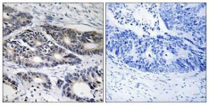 Immunohistochemical analysis of paraffin-embedded human colon carcinoma using Anti-Cytochrome P450 2R1 Antibody. The right hand panel represents a negative control, where the antibody was pre-incubated with the immunising peptide.