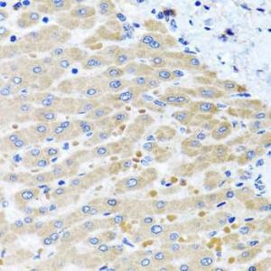 Immunohistochemistry analysis of paraffin-embedded human liver damage using Anti-DARS2 Antibody (A10227) at a dilution of 1:100 (40x lens). Perform microwave antigen retrieval with 10 mM PBS buffer pH 7.2 before commencing with IHC staining protocol.