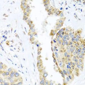 Immunohistochemistry analysis of paraffin-embedded human lung cancer using Anti-DARS2 Antibody (A10227) at a dilution of 1:100 (40x lens). Perform microwave antigen retrieval with 10 mM PBS buffer pH 7.2 before commencing with IHC staining protocol.