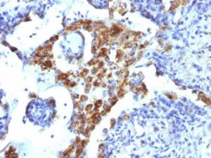 Immunohistochemical analysis of formalin-fixed, paraffin-embedded human lung adenocarcinoma using Anti-NAPSIN A Antibody [NAPSA/1239]