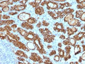 Immunohistochemical analysis of formalin-fixed, paraffin-embedded human thyroid carcinoma using Anti-Thyroid Peroxidase Antibody [TPO/1922]