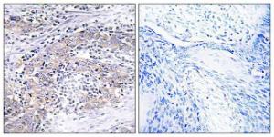 Immunohistochemical analysis of paraffin-embedded human cervix carcinoma tissue using Anti-CLN6 Antibody The right hand panel represents a negative control, where the antibody was pre-incubated with the immunising peptide