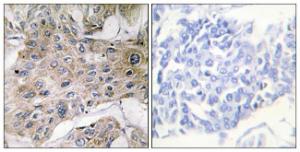 Immunohistochemical analysis of paraffin-embedded human breast carcinoma tissue using Anti-COX7S + COX7A2 Antibody. The right hand panel represents a negative control, where the antibody was pre-incubated with the immunising peptide