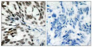 Immunohistochemical analysis of paraffin-embedded human breast carcinoma tissue using Anti-Retinoblastoma Antibody The right hand panel represents a negative control, where the antibody was pre-incubated with the immunising peptide