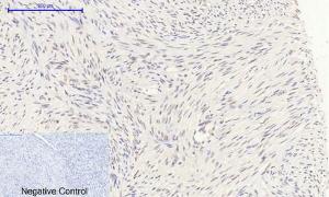 Immunohistochemical analysis of paraffin-embedded human uterus cancer tissue using Anti-Retinoblastoma Antibody at 1:200 (4°C overnight) Negative control was secondary antibody only