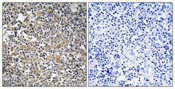 Immunohistochemical analysis of paraffin-embedded human lung cancer using Anti-MAST2 Antibody 1:100 (4°C overnight) The right hand panel represents a negative control, where the antibody was pre-incubated with the immunising peptide